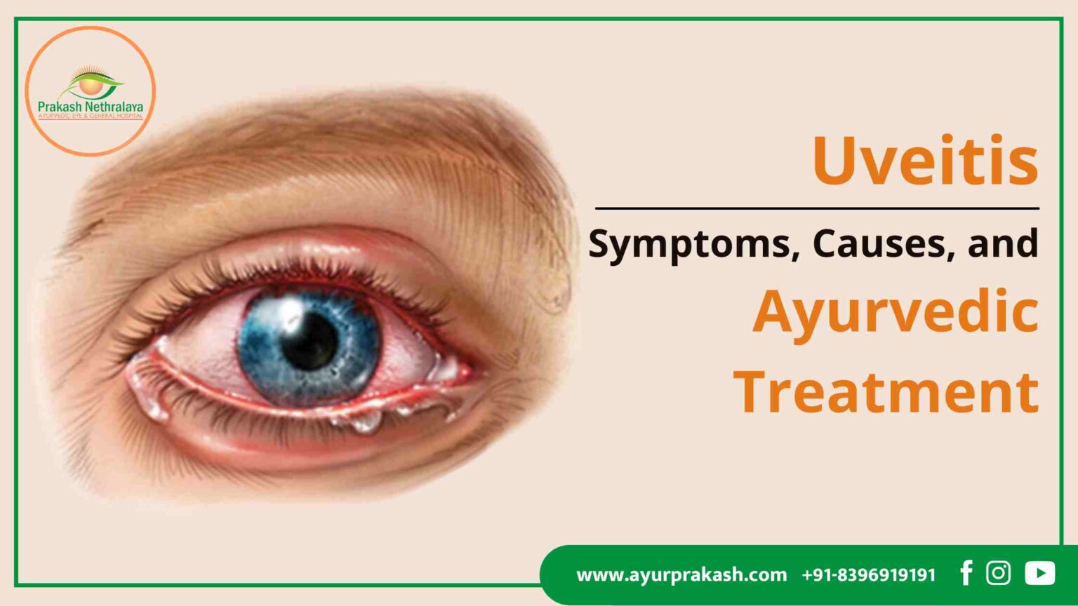 What Is Uveitis? Symptoms, Causes, and Best Course of Ayurvedic Treatment?