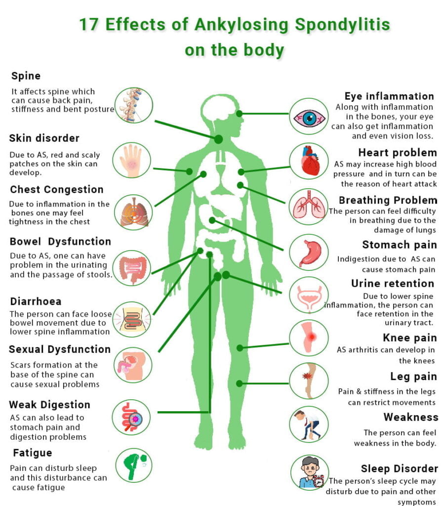 17 Effects of Ankylosing Spondylitis on the body