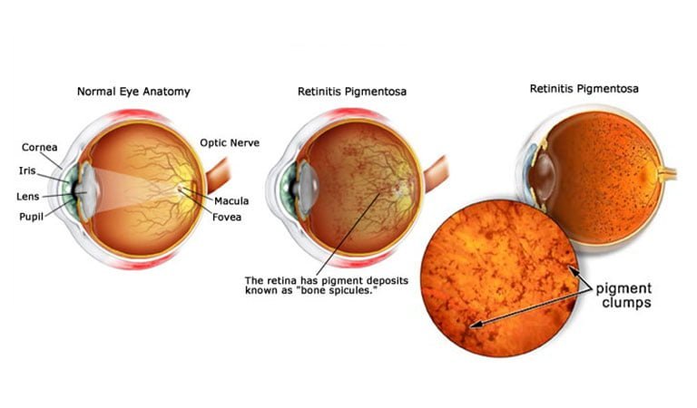 Retinitis pigmentosa Archives - Prakash Nethralaya