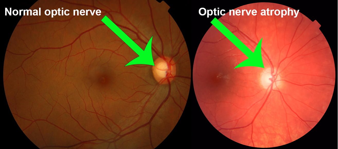 Optic Nerve Damage Treatment in Ayurveda: Effective Results